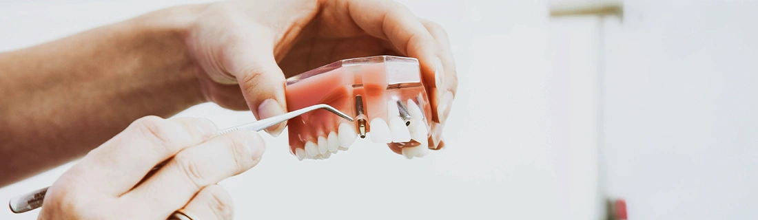 FC – Get a Confident Smile with Dental Implants at Clifton Dental Care FC – Get a Confident Smile with Dental Implants at Clifton Dental Care